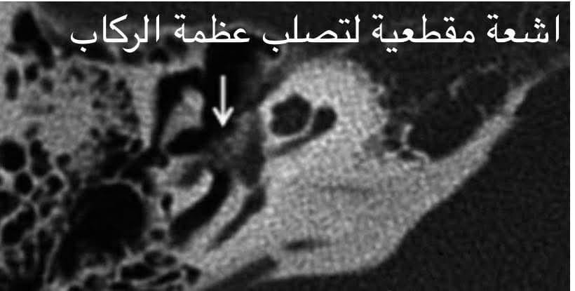 هل الرنين المغناطيسي يبيّن تصلّب عظمة الركاب؟