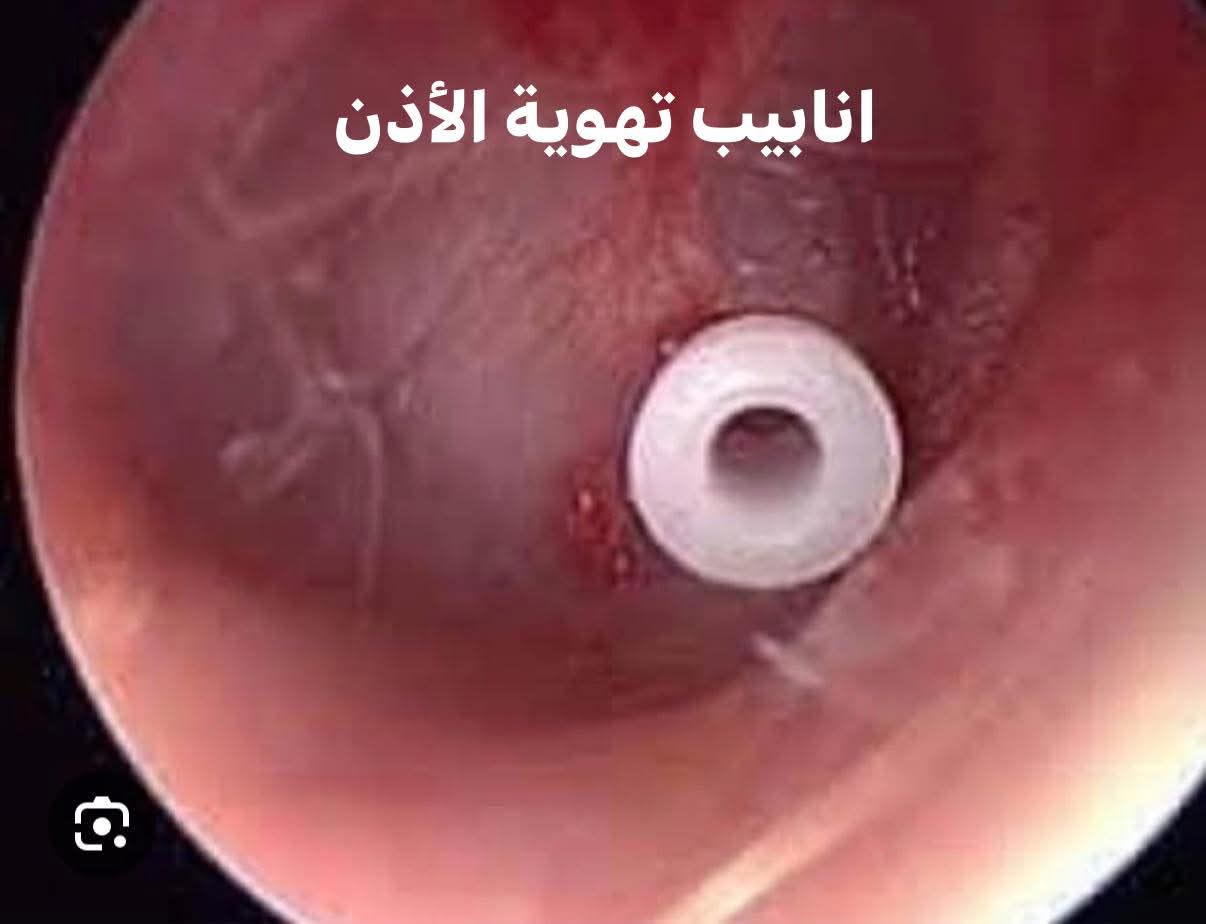 مقياس الطنين: ليه مهم ومكوناته